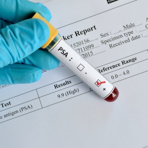 PSA Testing Cuts Deaths, Shows Value of Long-Term Screening