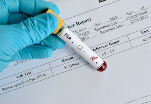 PSA Testing Cuts Deaths, Shows Value of Long-Term Screening