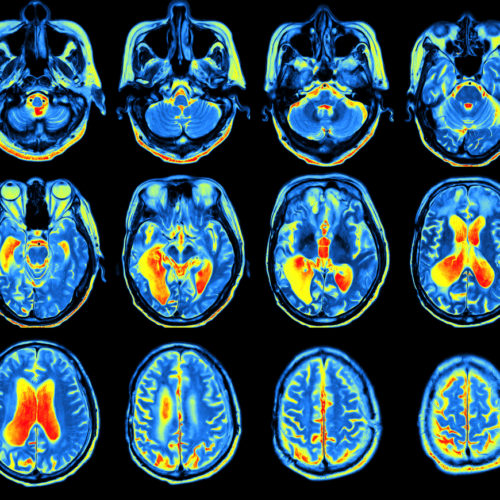 Brains of People with Sleep Apnea Show Increased Tau Protein Aggregates