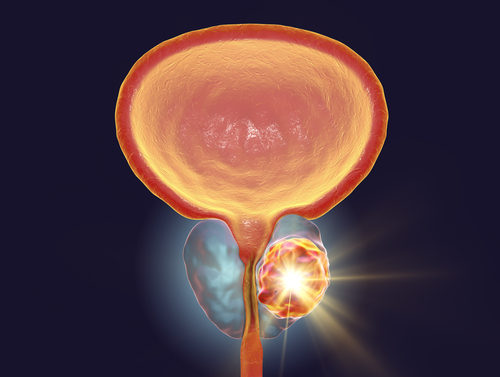 Some PC Patients Can Safely Receive Short but Intense Course of Radiation