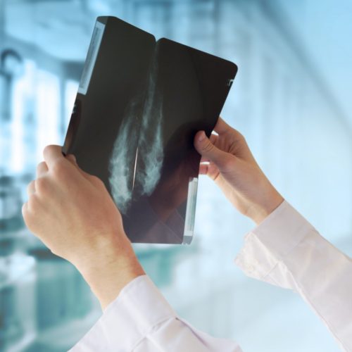 AI Matches Radiologists’ Skill at Detecting Breast Cancer on Mammograms