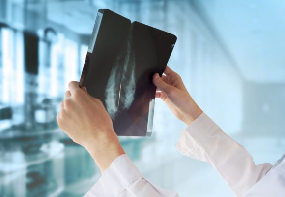 AI Matches Radiologists’ Skill at Detecting Breast Cancer on Mammograms