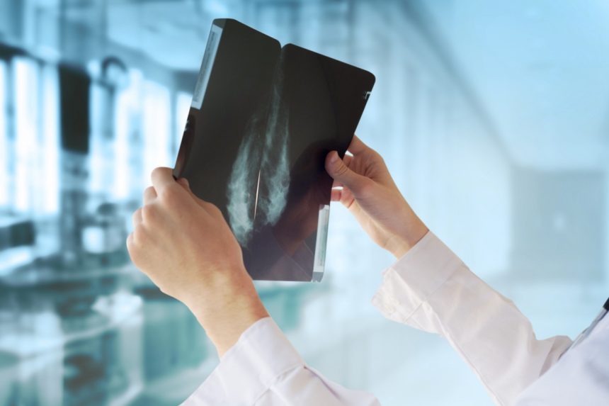 AI Matches Radiologists’ Skill at Detecting Breast Cancer on Mammograms