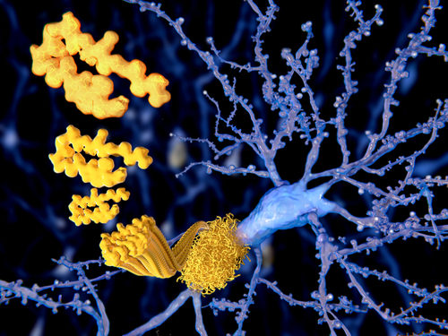 Gantenerumab Continues to Show Promise in Reduction of Amyloid Plaques