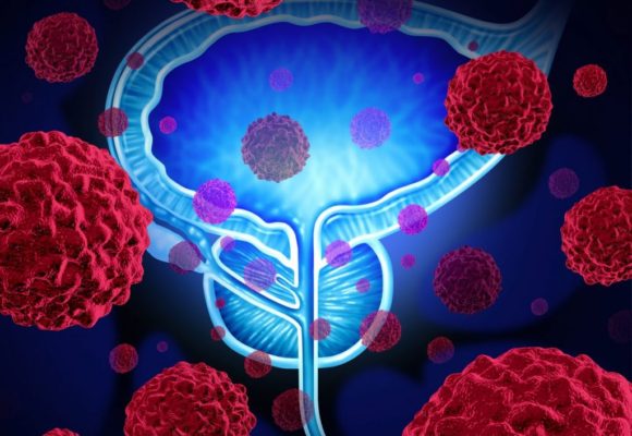 Liquid Biopsy Test Helping Select People with Advanced Prostate Cancer for Phase 2 Study of Pamiparib