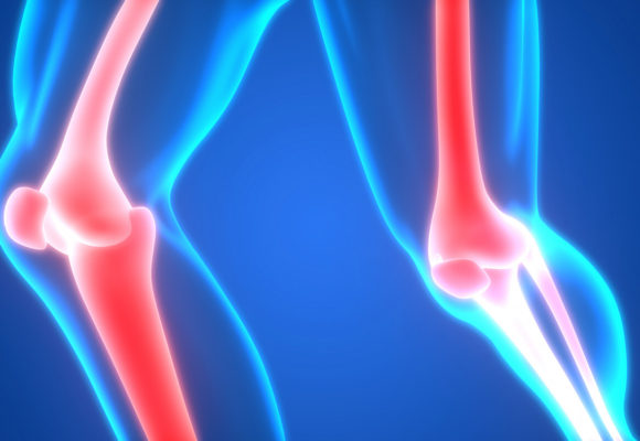 Long-term Treatment with Thiazide Diuretics May Lower Risk of Bone, Hip Fractures, Study Suggests