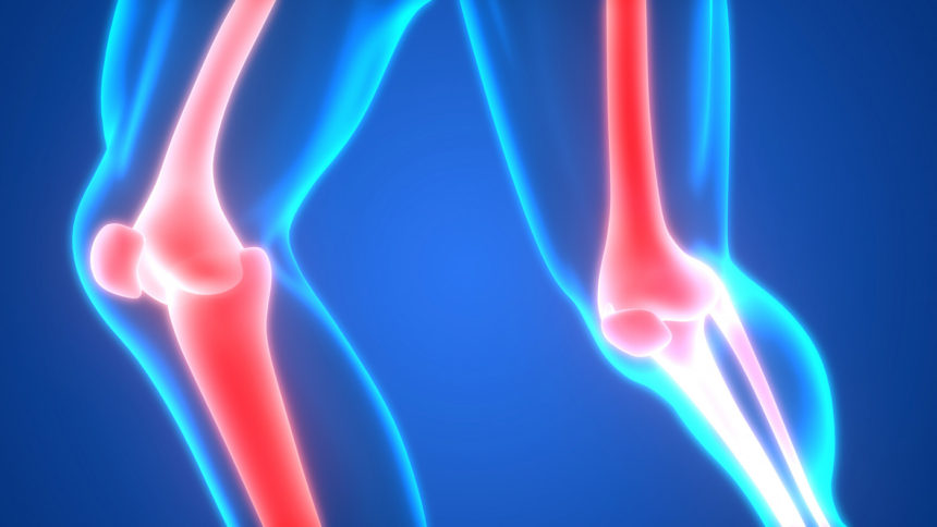 Long-term Treatment with Thiazide Diuretics May Lower Risk of Bone, Hip Fractures, Study Suggests