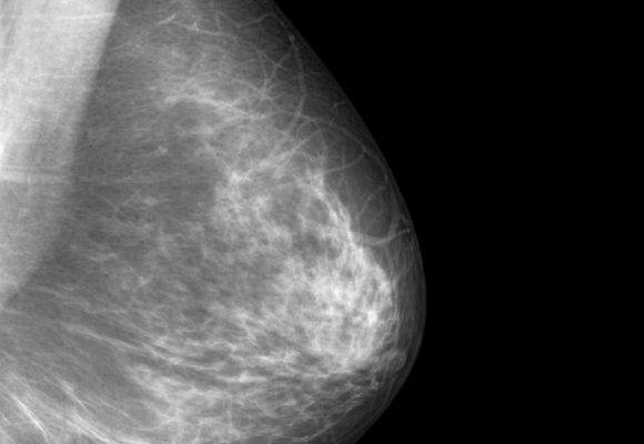 New AI-based Model Outperforms Current Methods of Predicting Breast Cancer Risk