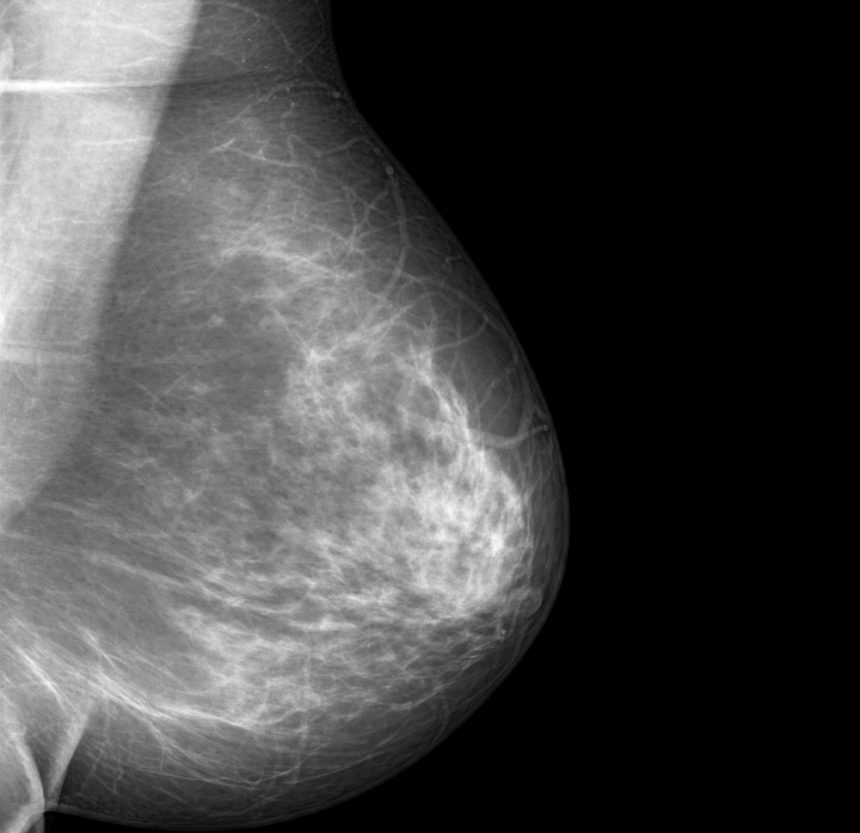 New AI-based Model Outperforms Current Methods of Predicting Breast Cancer Risk