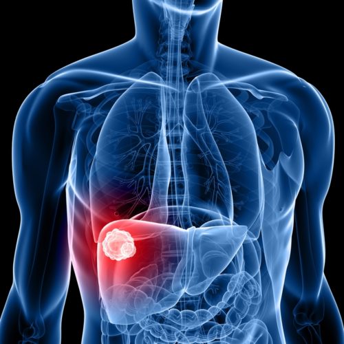 Tecentriq Combo Prolongs Life of Lung Cancer Patients with Liver Metastases, Phase 3 Study Shows