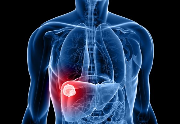 Tecentriq Combo Prolongs Life of Lung Cancer Patients with Liver Metastases, Phase 3 Study Shows