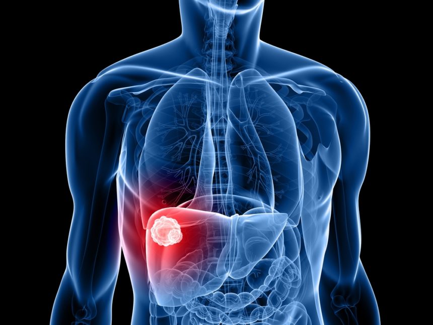 Tecentriq Combo Prolongs Life of Lung Cancer Patients with Liver Metastases, Phase 3 Study Shows