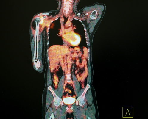 68Ga-PSMA-11 Better than Axumin at Detecting PC Recurrence, Trial Shows