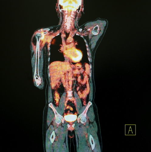 68Ga-PSMA-11 Better than Axumin at Detecting PC Recurrence, Trial Shows