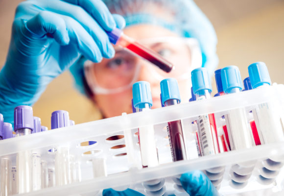 Blood Test Ably Identifies Ovarian Cancer Prior to Surgery, Clinical Trial Planned