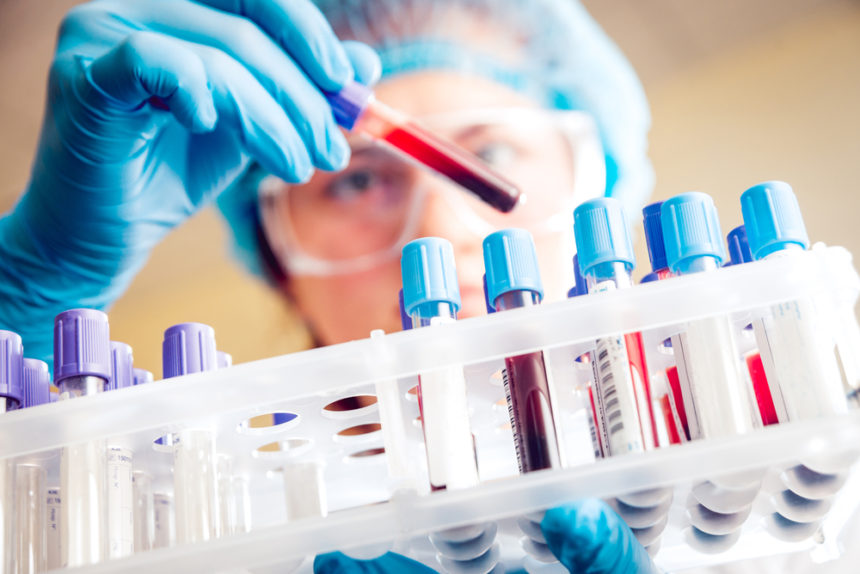 Blood Test Ably Identifies Ovarian Cancer Prior to Surgery, Clinical Trial Planned