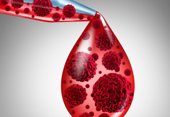 ADXS-NEO Provoked Strong Immune Response in Advanced Cancer Patient, Early Trial Data Show