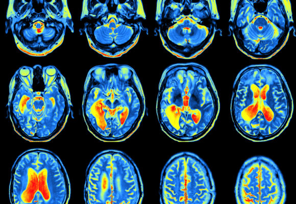 FDG PET Scan More Accurately Assesses Severity of Cognitive Decline in Alzheimer’s, Study Finds