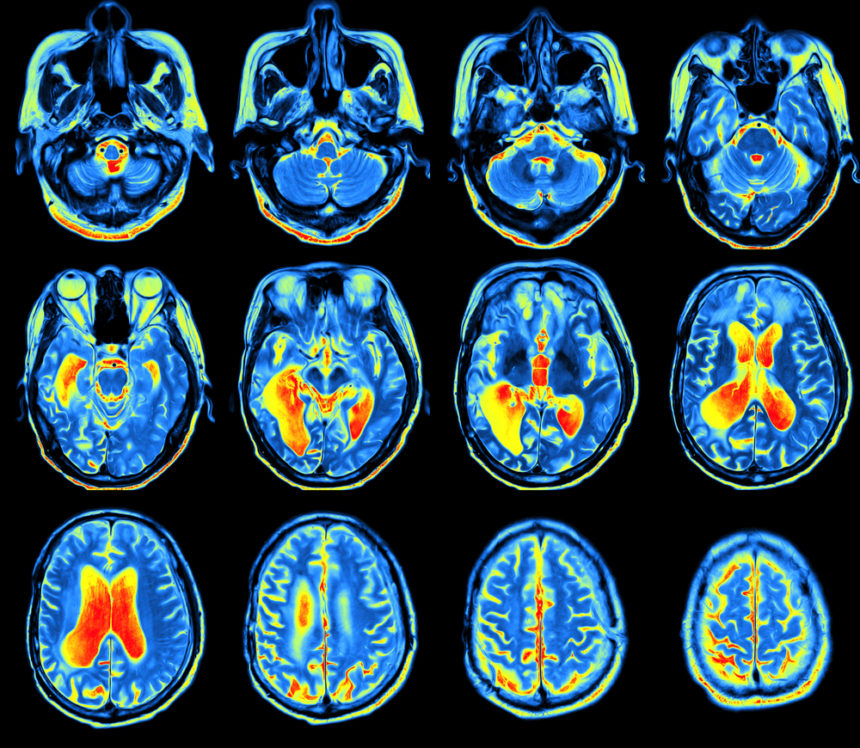 FDG PET Scan More Accurately Assesses Severity of Cognitive Decline in Alzheimer’s, Study Finds