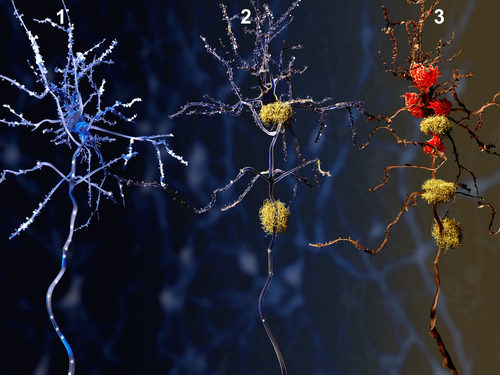 Targeting Single Enzyme May Produce Multiple Benefits for Alzheimer’s, Mouse Study Suggests