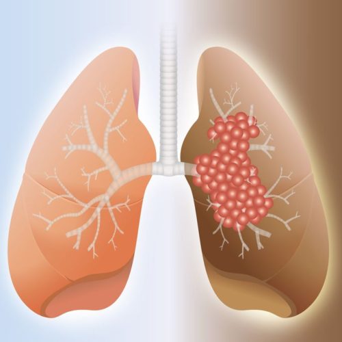 Opdivo-Yervoy Plus Shorter Chemotherapy Course Extends Survival of Patients with Advanced Lung Cancer, Early Trial Data Show