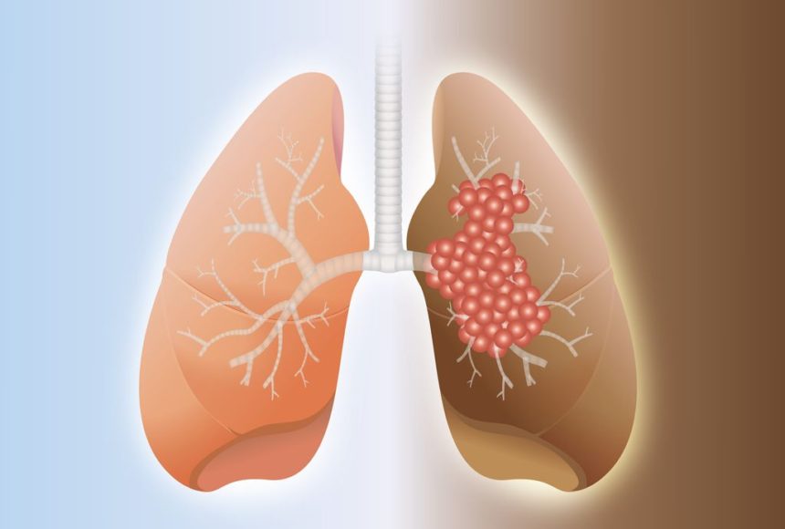 Small cell lung cancer opdivo