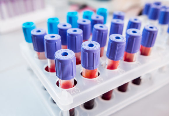 High Blood Levels of 2 Hormones May Be Linked to Prostate Cancer Development, Study Says