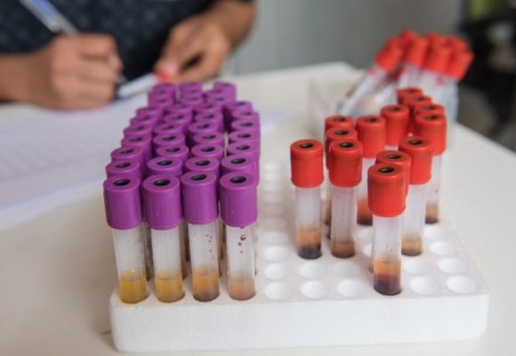 Imbruvica Extends Time to Disease Worsening over Prior Regimen in MCL, Data Shows