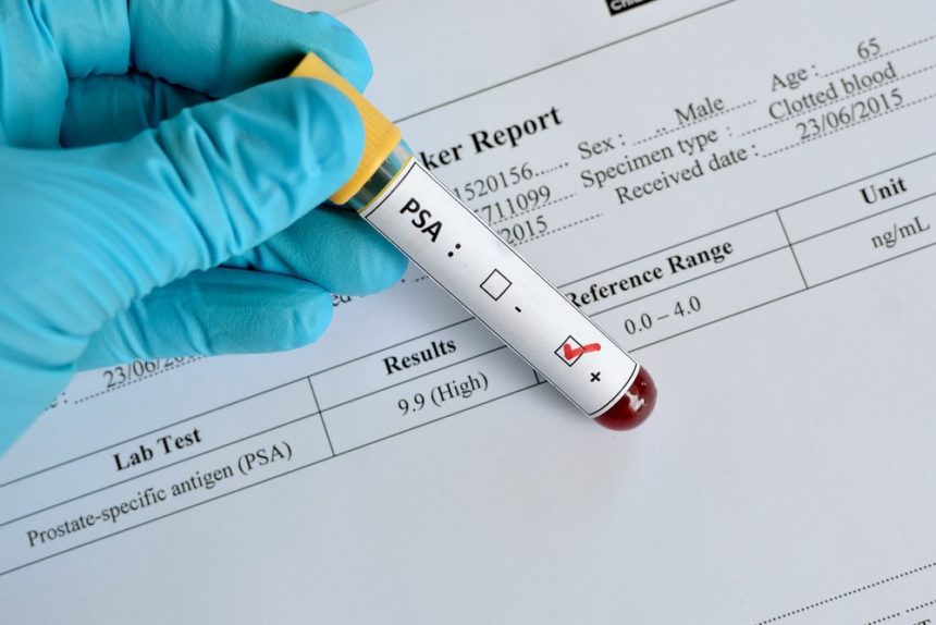 Recommendation Against PSA Routine Screening May Have Contributed to Higher Rates of Advanced PC