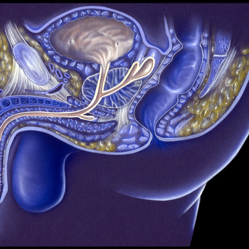 Laser Focal Therapy Effective, Causes Few Side Effects, 10-Year Trial Data Shows