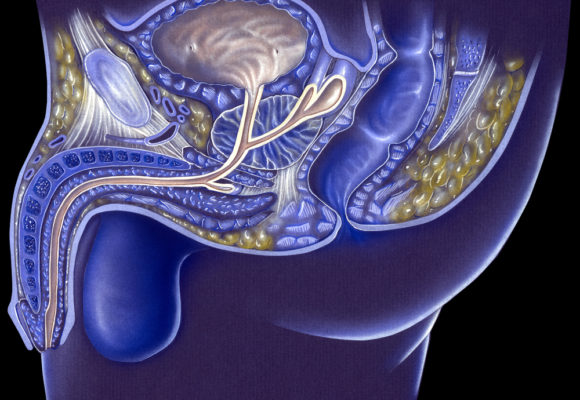 Laser Focal Therapy Effective, Causes Few Side Effects, 10-Year Trial Data Shows