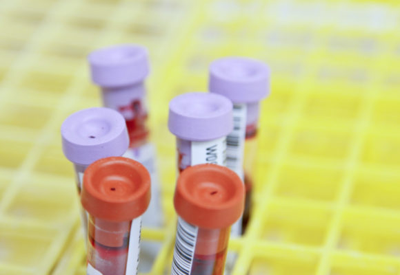 ONCOTracker, Binding Site Team Up to Develop sBCMA Monitoring Test