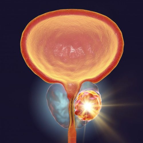 Trial to Test Focal Laser Ablation Therapy for Localized Prostate Cancer