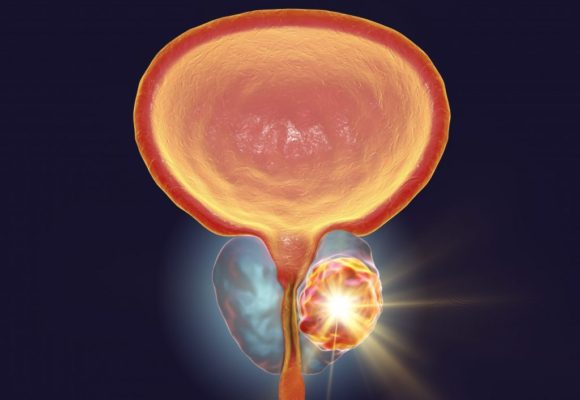 Trial to Test Focal Laser Ablation Therapy for Localized Prostate Cancer