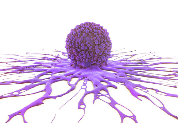 Blocking Glutamine Metabolism May Help Combat OCCC Tumors