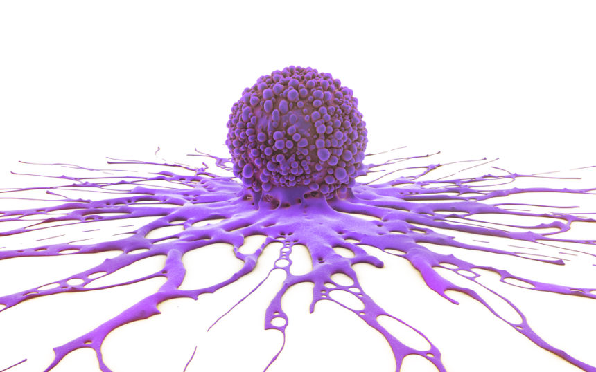 Blocking Glutamine Metabolism May Help Combat OCCC Tumors