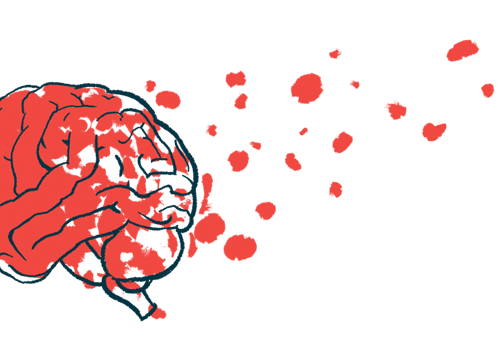 Portable Neurostimulator Safe With Home Use, Alzheimer’s Trial Finds